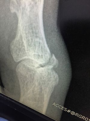 X ray of Nick's toe.